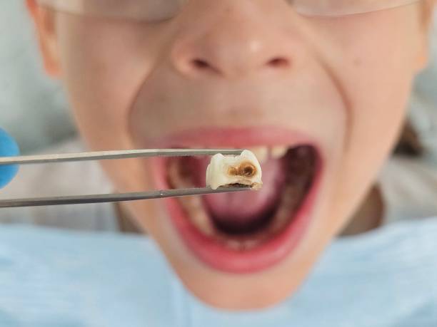 Best Emergency Dental Care for Abscessed Tooth in Bonny Doon, CA
